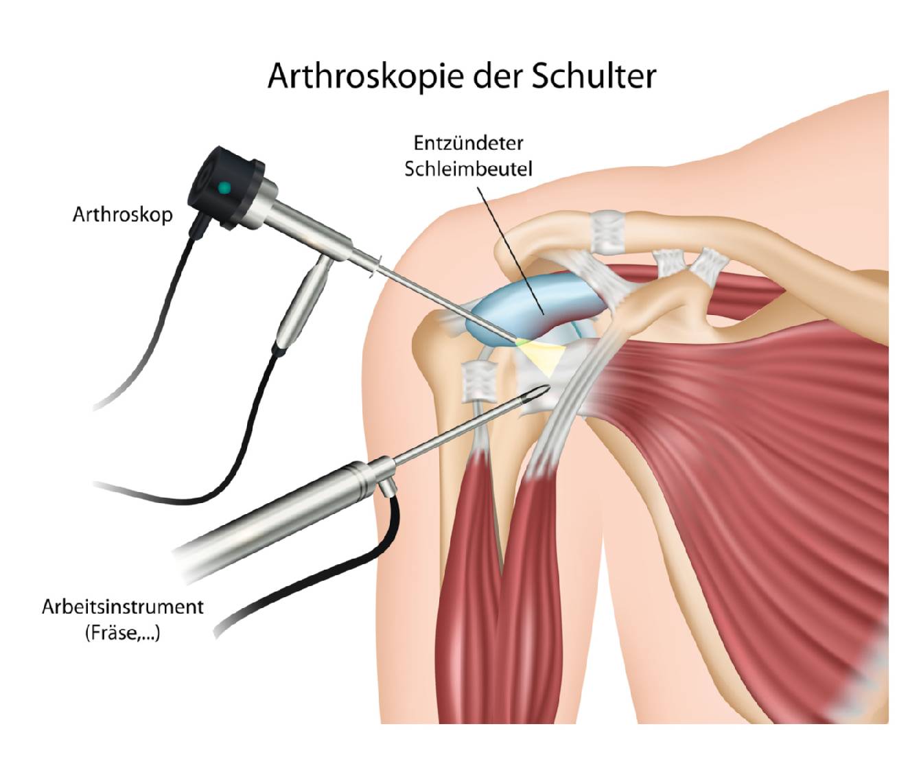 Arthroskopie Schultergelenk, Gelenkspiegelung