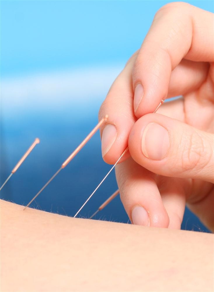 Akupunktur wird unter manchen Vorraussetzungen von den gesetzlichen Krankenkassen erstattet.