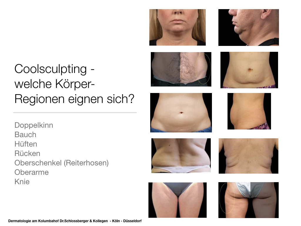 Coolsculpting - Sanfte Fettreduktion durch Kälte - Kryolipolyse Köln