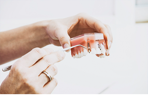 Unsere Zähne benötigen wir unser Leben lang – darum wissen wir von der Wichtigkeit eines Zahnersatzes und beraten Sie dazu gern in Brühl.