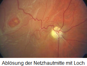 Praxis Fur Augenheilkunde In Chemnitz Netzhautablosung Praxis Fur Augenheilkunde In Chemnitz Netzhautablosung