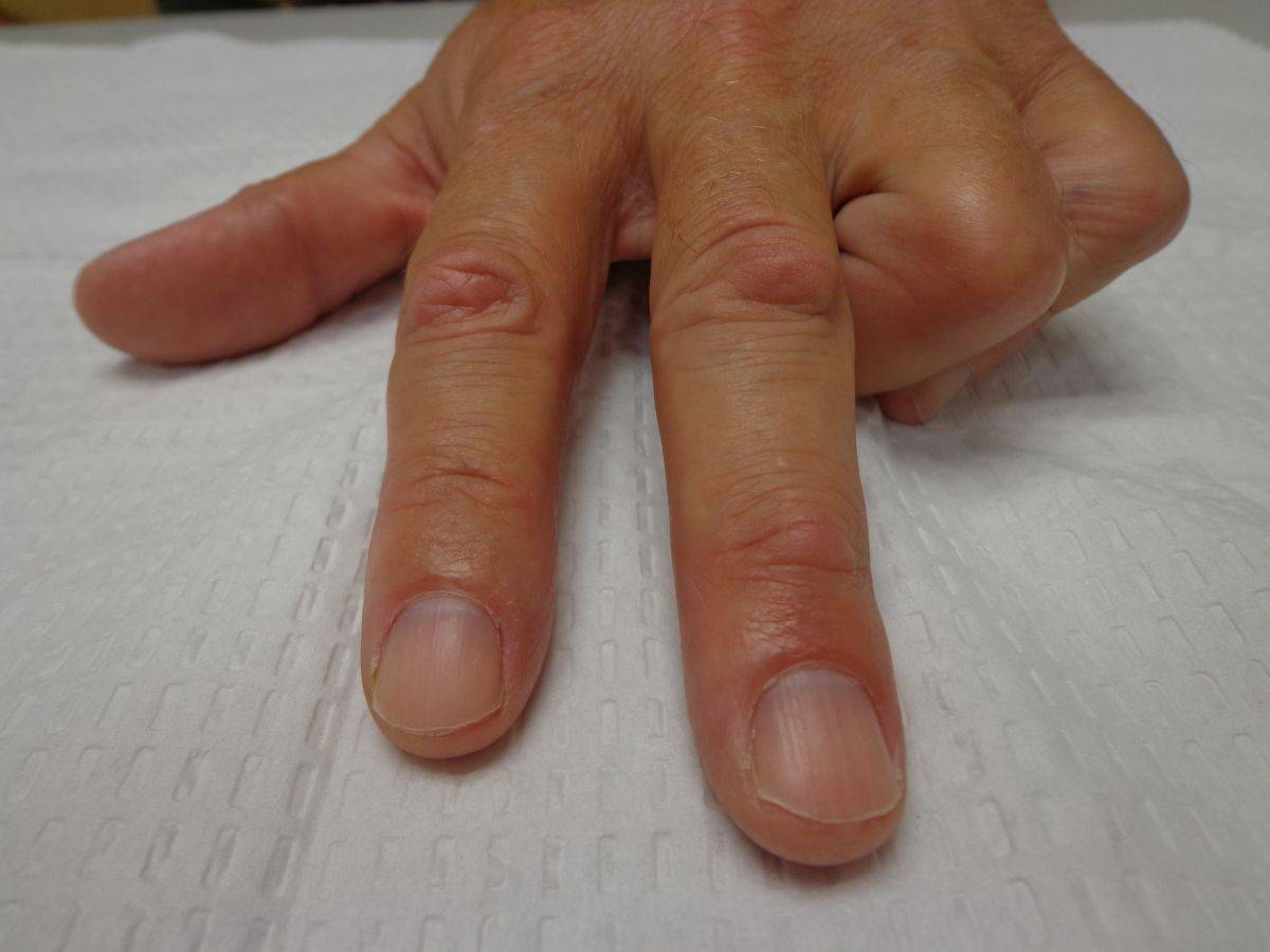 Knubbel im finger