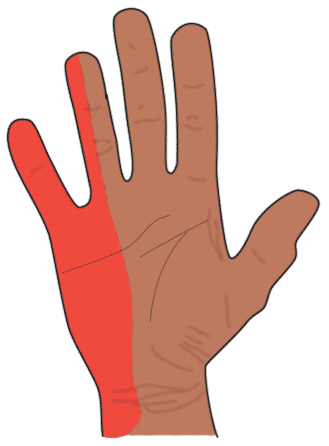 Heidemann Hand Und Ellenbogenchirurgie In Hurth Karpaltunnelsyndrom Heidemann Hand Und Ellenbogenchirurgie In Hurth Karpaltunnelsyndrom