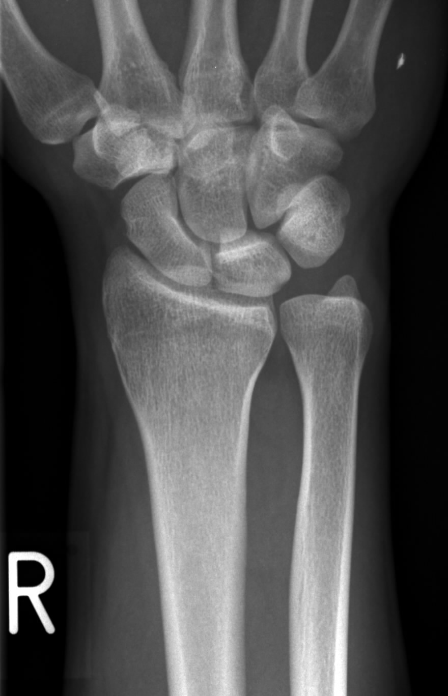 Heidemann Hand Und Ellenbogenchirurgie In Hurth Ulnares Impaktionssyndrom Heidemann Hand Und Ellenbogenchirurgie In Hurth Ulnares Impaktionssyndrom