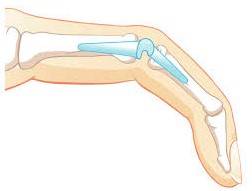 Heidemann - Hand- und Ellenbogenchirurgie in Hürth - Fingergelenkersatz