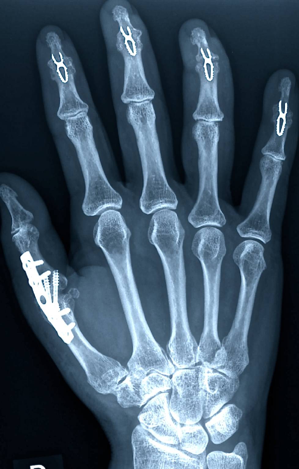 Sie brauchen eine Experten für Handchirurgie in Hürth? - Dann treten Sie gerne mit Heidemann Hand- und Ellenbogenchirurgie in Kontakt!