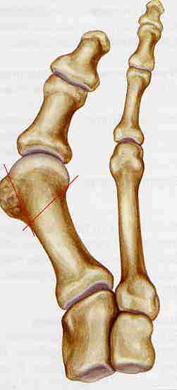 Praxis Dr Nikolaus Schafer Ihr Orthopade In Mayen Hallux Valgus Praxis Dr Nikolaus Schafer Ihr Orthopade In Mayen Hallux Valgus